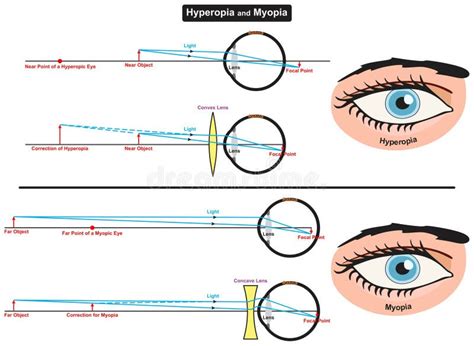 Shortsightedness Difference Stock Illustrations 1 Shortsightedness Difference Stock