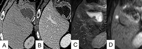 Tumeurs neuroendocrines pancréatiques FMC HGE