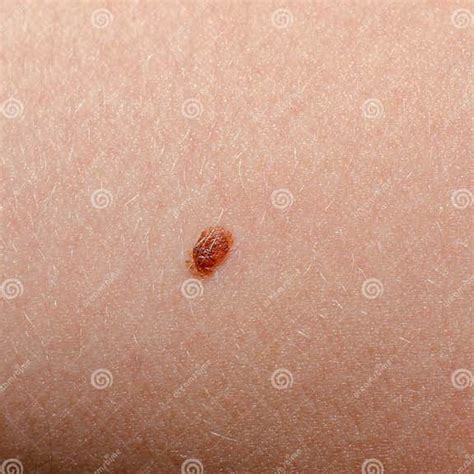 Nevus Or Mole On The Human Body Close Up Skin Cancer Keratosis Or