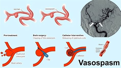 Vasospasm YouTube