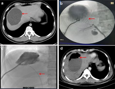 Computed Tomography CT And Fluoroscopy Images Showing The Secondary