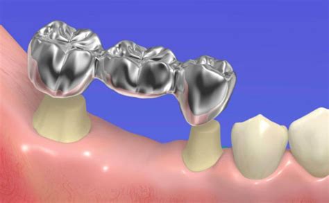 Puente Dental Tipos Que Es Mejor Cómo Hacer Y Poner Cuánto Vale El