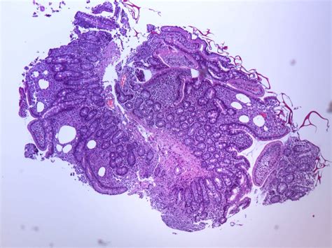 Pathology Outlines Whipple Disease