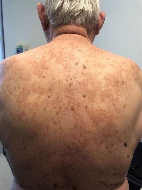 Recurring Rash On Back Clinical Advisor