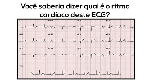 Você Saberia Dizer Qual Ritmo Cardíaco Deste Ecg Cardiosite