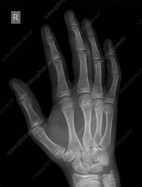 Metacarpal Fracture X Ray Stock Image C056 4178 Science Photo