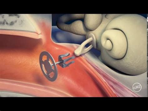 Ossicular replacement prosthesis surgery - malioon