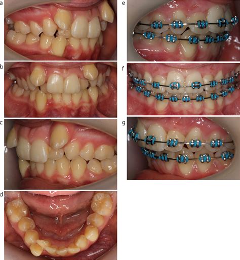 Orthodontic Update Management Of Lower Incisor Extraction Cases Part