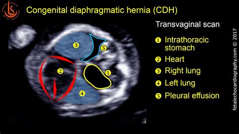 Congenital Diaphragmatic Hernia Ultrasound