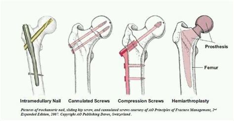 Kellgren lawrence grading scale – Artofit