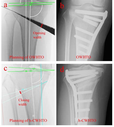 Hybrid Closed Wedge High Tibial Osteotomy Maintains The Leg Length