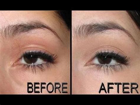 Under Eye Puffiness at best price in Bengaluru by Revive Aesthetic ...