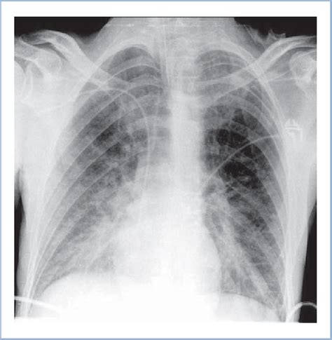 Chest X Ray Anteroposterior View Download Scientific Diagram