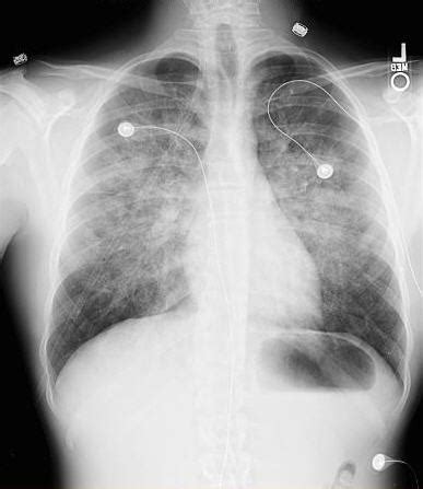 Pulmonary Edema Radiology