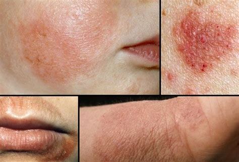 17 Best images about Eczema Rashes on Pinterest | Skin rash, Soaps and ...