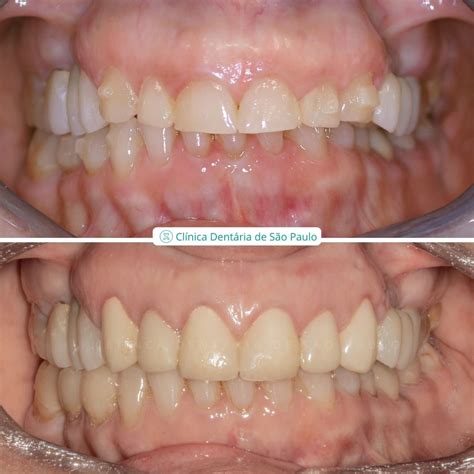 Periodontologia Dentisteria Caso 1 Clínica Dentária São Paulo