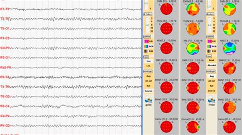 Cartografia Do EEG Medibrain