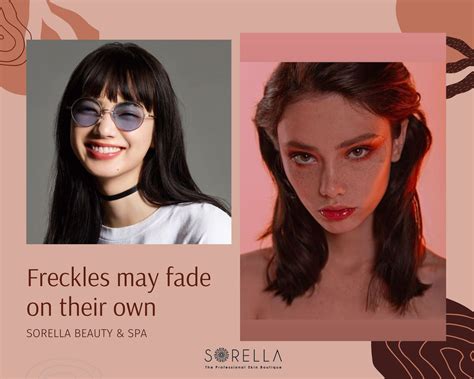 Freckles Treatment: 7 methods to get rid of Freckles - Sorella Beauty