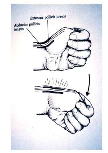 Ortho Final Common Injuries Of The Elbow Wrist And Hand Flashcards