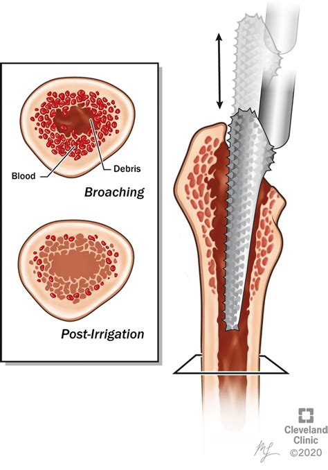 Sequential broaching of the medullary canal followed by irrigation and ...