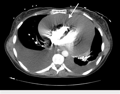 Figure 1 From A Case Of Primary Lung Adenocarcinoma With Two Uncommon Presentations