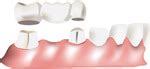 Complicaciones De Los Implantes Dentales A Corto Y Largo Plazo