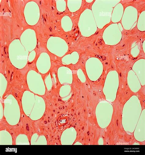 Uterine Fibroid Light Micrograph Of A Section Through A Lipoleiomyoma