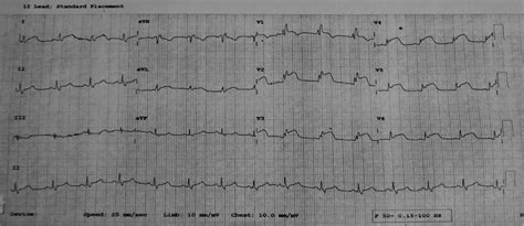 Risk Factors in Young Female Patient with Polycystic Ovary Syndrome