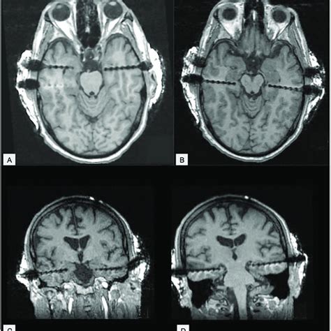 Axial A And B And Coronal C And D MRI MPRAGE Demonstrating