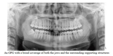 Anatomical Landmarks On Panoramic X Ray