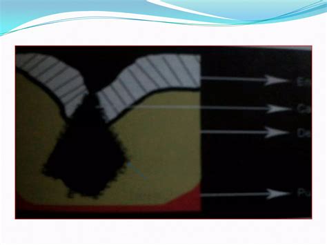 Preventive resin restoration ppt | PPTX