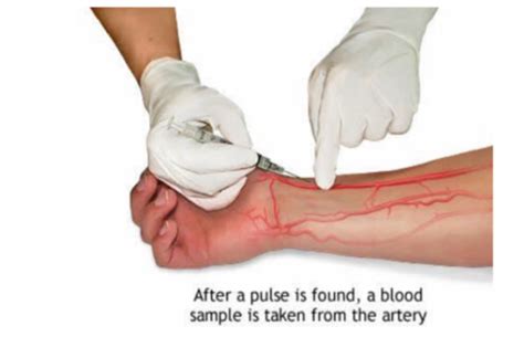 SPO Keperawatan Pengambilan Sampel Darah Arteri AGD Mediaperawat Id