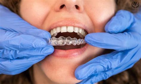 Can Mk Aligners Correct Dental Crowding Dr Murat Kaptac