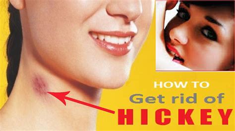 How To Get Rid Of A Hickey Home Remedies For Kiss Marks Remove