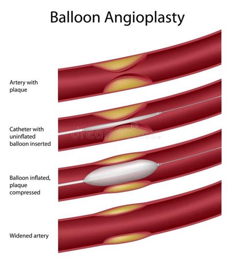 Peripheral Arterial Disease Pad Basics And Treatment Options