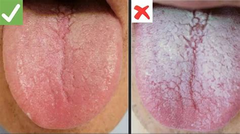 Health Appearance Of White Tongue Can Be A Sign Of Deficiency Of This