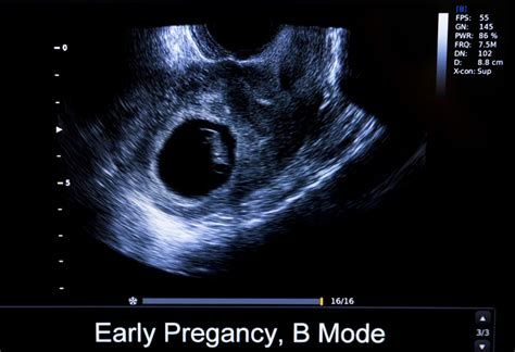 Yolk Sac 6 Weeks