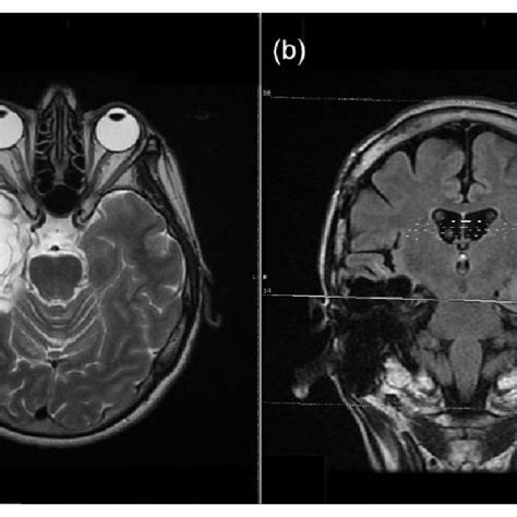 MRI of the brain (a): axial T2 sequence image shows encephalomalacia ...