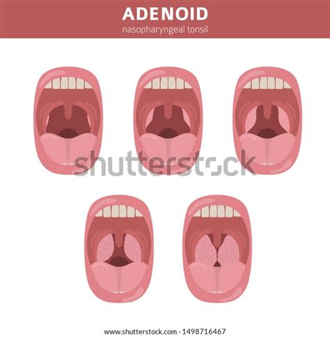 Nasal Throat Nasopharynx Diseases Adenoids Diagnosis Stock Vector