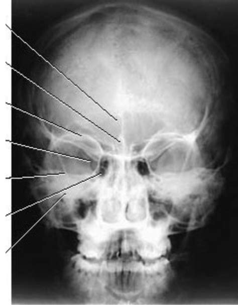 Skull Anatomy Diagram Quizlet