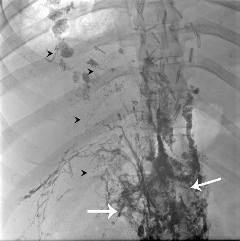 Fluoroscopic Image Of Patient During The Embolization Procedure