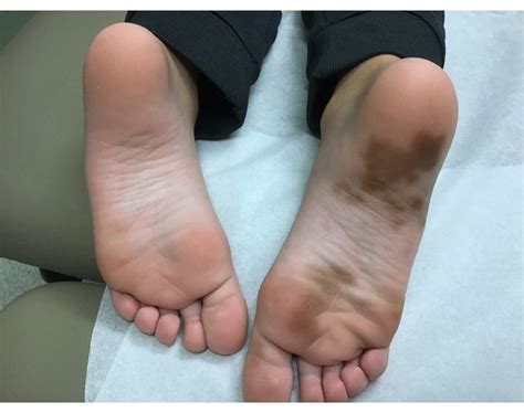 Painless Black Spot On Top Of Foot Cheap Sale Emergencydentistry