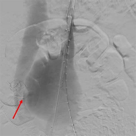 Intraoperative Angiography Demonstrating An Abdominal Aortic Aneurysm