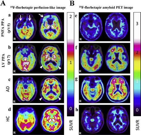 Comparisons Of Dual Phase 18 F Florbetapir Pet Images In A Patient With