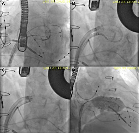 Transcatheter Mitral Valve Replacement Procedure Download Scientific