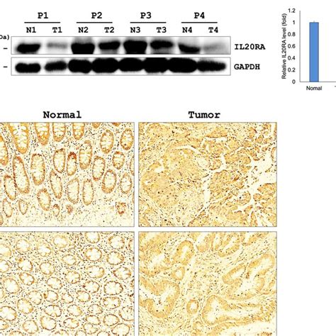 Il Ra Pjak Pstat And Pstat Expression In Human Crc Tissues A