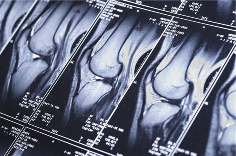 How To Read a Knee MRI — Dr. Bill Sterett