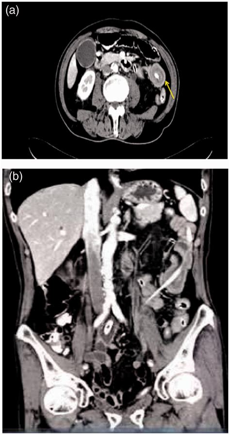 Clinical Characteristics Of Nasointestinal Ileus Tube Induced Intussusception Three Case