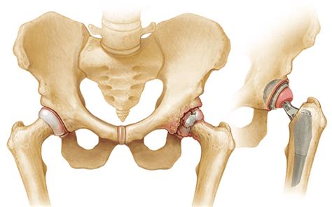 Understanding Hip Replacement: Types, Candidates, and Procedures | Thunder Basin Orthopaedic