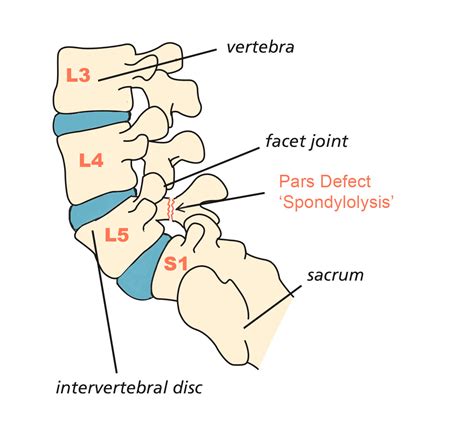 Pars Defect - Spines Dorset